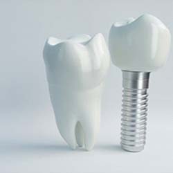 Parts of dental implants in McKinney