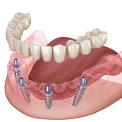 digital illustration of how All-On-4 dental implants work