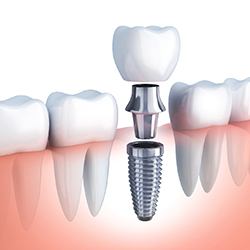 Model of a dental implant, abutment, and crown