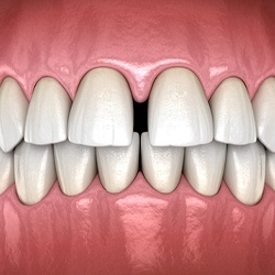 Digital diagram of gap between front teeth in McKinney before braces