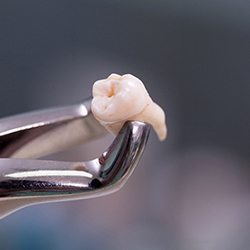 dental forceps holding a wisdom tooth