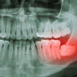 A dental X-ray that highlights an impacted wisdom tooth