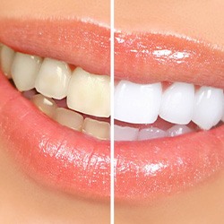 Before and after teeth whitening