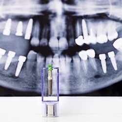 dental implant and X-ray for dental implant procedure in McKinney
