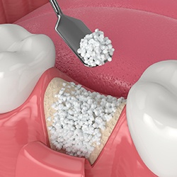 bone grafting illustration for dental implant procedure in McKinney