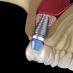 sinus lift illustration for dental implant procedure in McKinney