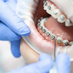 McKinney orthodontist places braces on patient