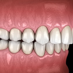 Illustration of an overbite