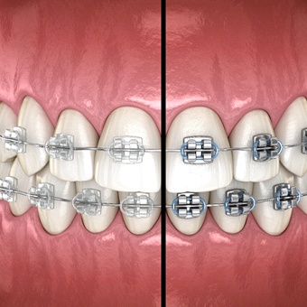 side-by-side comparison of metal braces and ceramic braces in McKinney
