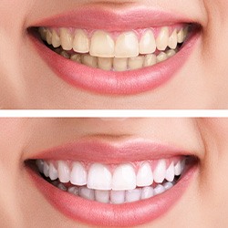 Closeup of patient's smile before and after teeth whitening