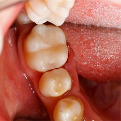 A set of teeth after receiving tooth-colored fillings