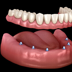 Six dental implants in McKinney securing a full denture into place