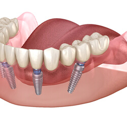 Model of a dental implant supported denture on the lower jaw