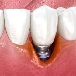 Close-up illustration of infection around a dental implant
