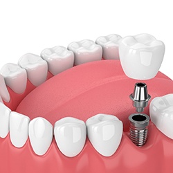 Single dental implant with a dental crown