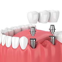 Two dental implants supporting a dental bridge