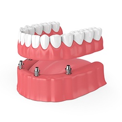 Four dental implants supporting a full denture