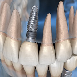 Model of a dental implant in the upper jaw