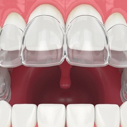 A digital image that shows an aligner going on over the top row of teeth