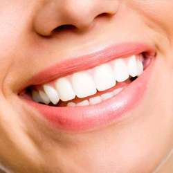 Closeup of smile during Invisalign treatment