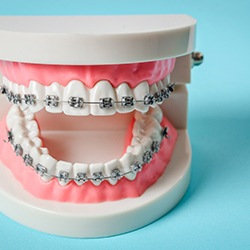 An image of a mouth mold that has traditional metal braces affixed