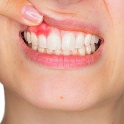 Closeup of patient lifting lip up to reveal red gums from gum disease
