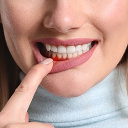 A woman revealing her deep gum inflammation
