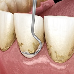 A 3D illustration of the scaling and root planing process