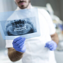 Dental x-ray of tooth in need of root canal therapy