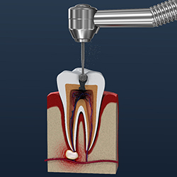 3-D model of a root canal