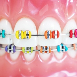 Closeup of rainbow-colored braces in McKinney