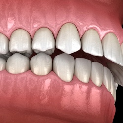 Digital diagram of overbite in McKinney before braces