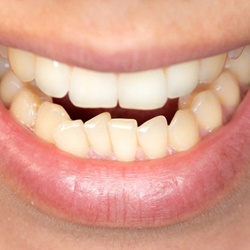 Closeup of crooked crowded teeth in McKinney before braces