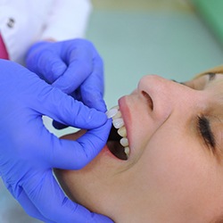 Patient getting a porcelain veneer after deciding among the treatment options