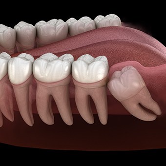 a digital illustration showing how wisdom teeth grow in
