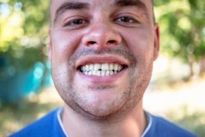 a person smiling to show their chipped tooth