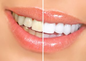 Yellow teeth before and after treatment