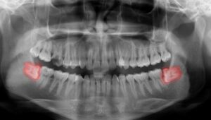 Dental X-ray showing two impacted wisdom teeth